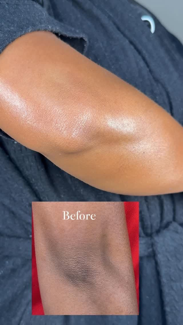 Hyper Pigmentation Combo 3 Piece Set - Before and After results