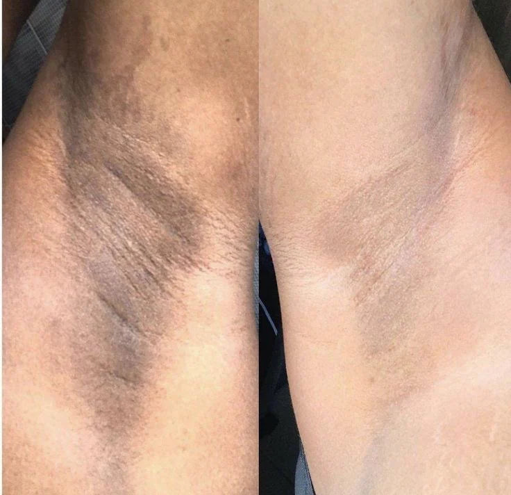 Dark Inner Thigh Buster Combo (Lotion & Scrub) – Noticeable Change in 2 Weeks!