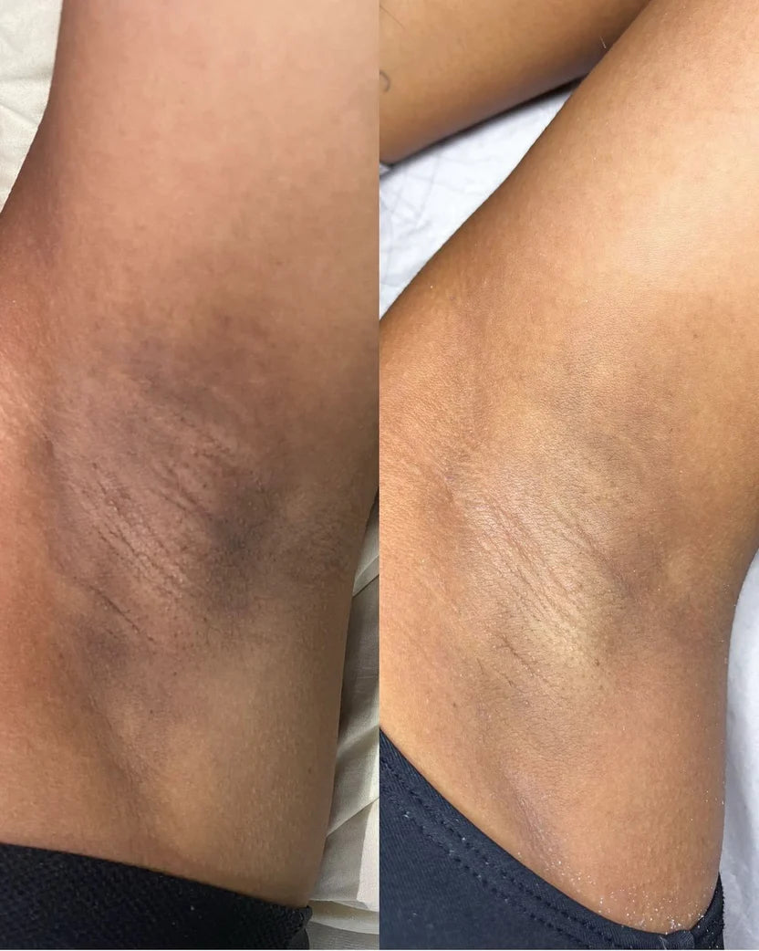 Hyper Pigmentation Clearing Soap